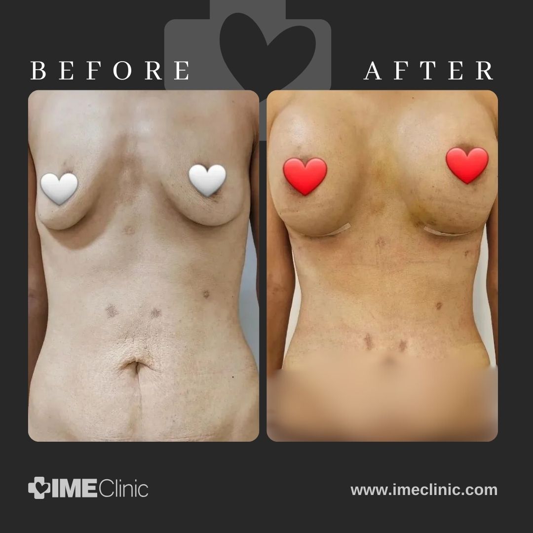 Before and after image highlighting the transformative effects of breast lifting surgery. The before photo shows a less voluminous chest, while the after photo reveals an enhanced, fuller appearance. Decorative hearts cover the chest areas in both images.